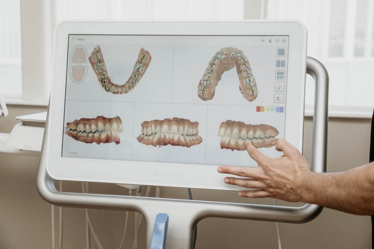 a 3-d model of teeth on the screen of an intraoral scanner