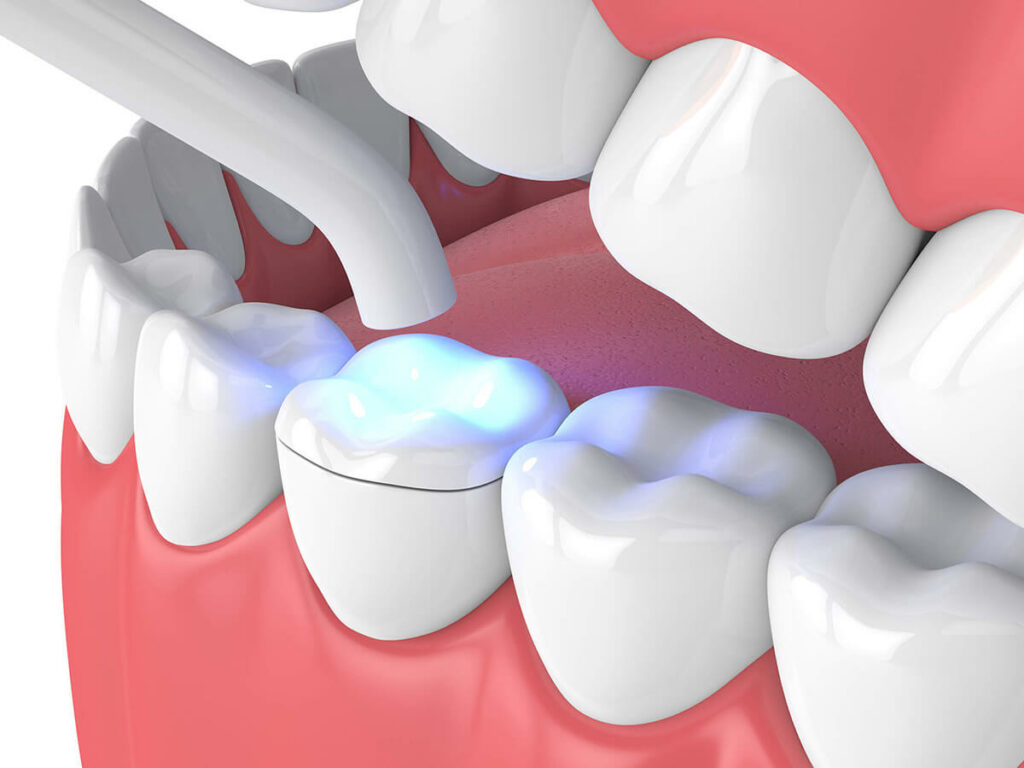 dental inlays and onlays