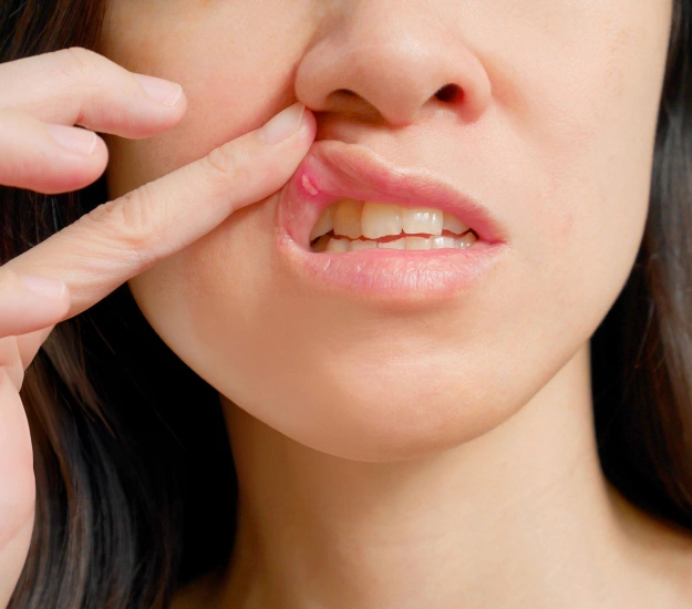 Laser Canker Sore Treatment Long Beach CA - Long Beach Dental Health