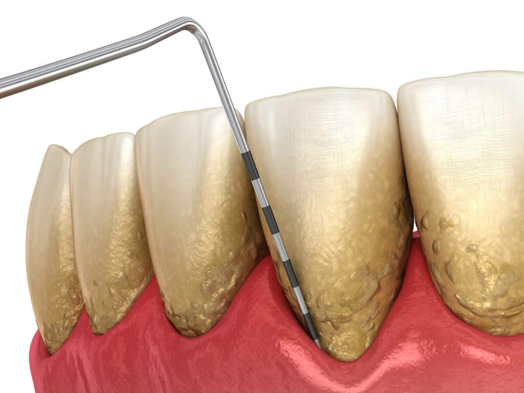 periodontal disease measurement tool